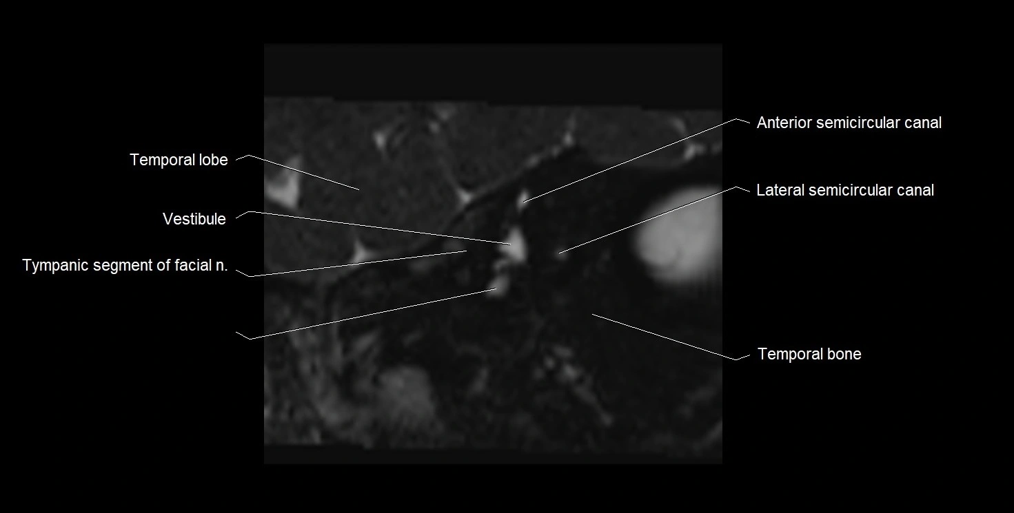 Internal auditory meatus (IAM) 3T sagittal cross sectional anatomy image 6.webp